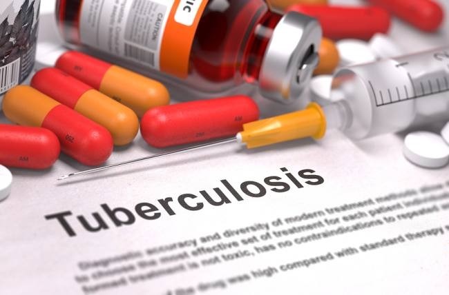 Drug use and injection drug use are essential factors in tuberculosis (TB) epidemiology in developed and developing countries. / Photo: Adobe Stock.